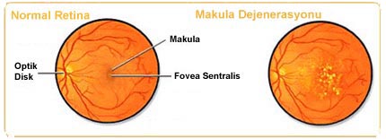 Yaşa Bağlı Makula Dejenerasyonu2 hastalık